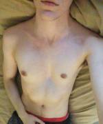 Pectus Excavatum/Trans Man/ 25/ No Surgery/ 2 Years On T. Anyone With Pe Out There?