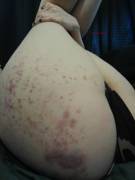 I Got Flogged On Stage This Weekend... Covered All Over My Back &Amp;Amp;Amp; Ass ...