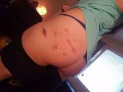 The Bruises Make Me [F]Eel Sexy