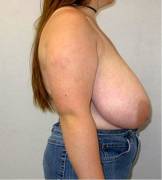 Reduction Before Pics