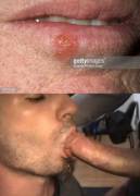 I'm A Young Gay Man Who Has A Fetish For Men With Coldsores And Who's Looking For ...