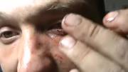 Guy Picks And Pulls Piece Of His Eyeball Out (Removed From Wtf)