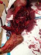 My Girlfriend Works At A Local Hospital, This Is What Happens When A Moped Meets ...