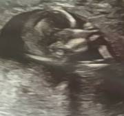 Interracial Baby In A Black Womb