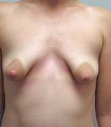 This Makes Me Sad, It Looks Like A Clinical Shot Just Before &Amp;Quot;Augmentation&Amp;Quot; ...