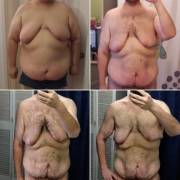 36M - 17 Months Progress, -202 Lbs, Hope To Get Chest Surgery Soon