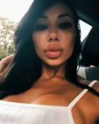 Pumped With Botox And Filler