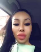 Freshly Filled Lips And Frozen Face