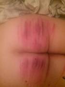 After The [F]Irst Time We Tried My New Acrylic Cane