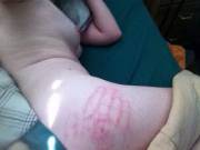 This Was The Morning After. Took Two Weeks To Completely Go Away.