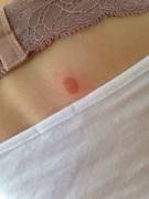 Wanted To Be Kinky With So, Now Have A Burn On My Back.