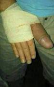 Back From The Er. Broken Thumb.