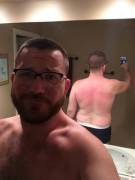 Damn My Delicate Irish Skin!