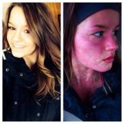 Girl Affected By Allergic Reaction.