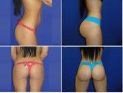 Before And After Booty Implants!