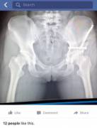 Girl Posts X-Ray To Facebook