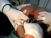 Completely Inserted Dildo Medically Removed From Woman's Ass